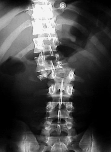 Le déplacement des disques cervicaux le traitement